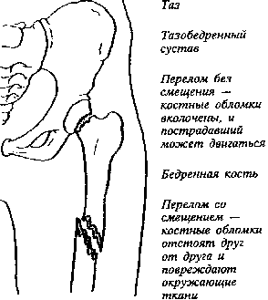 Какой вид травмы показан на рисунке какие кости повреждены